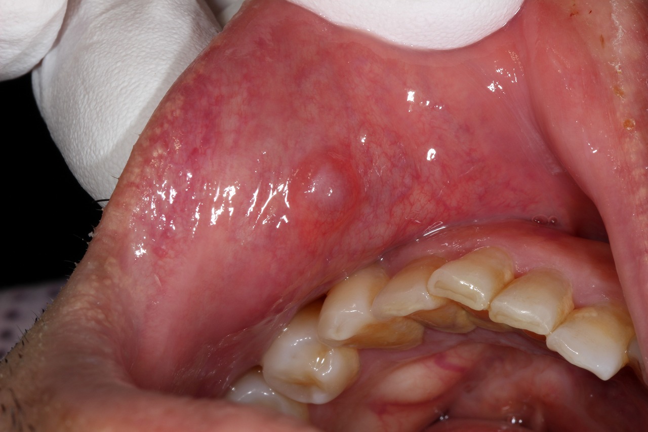 口 の 中 粘液 嚢胞
