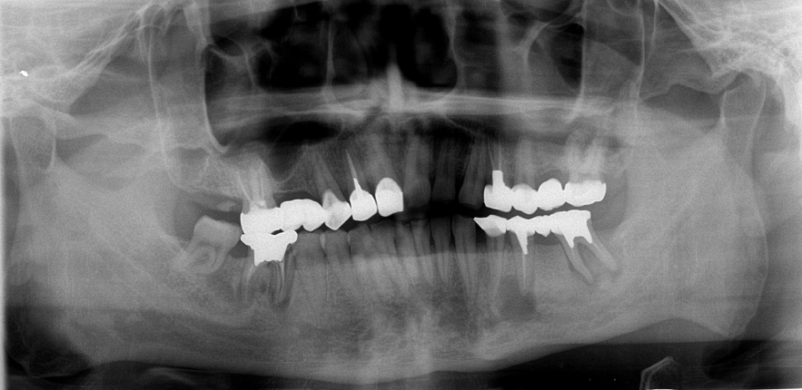 やましろ歯科口腔外科のパノラマレントゲン写真
