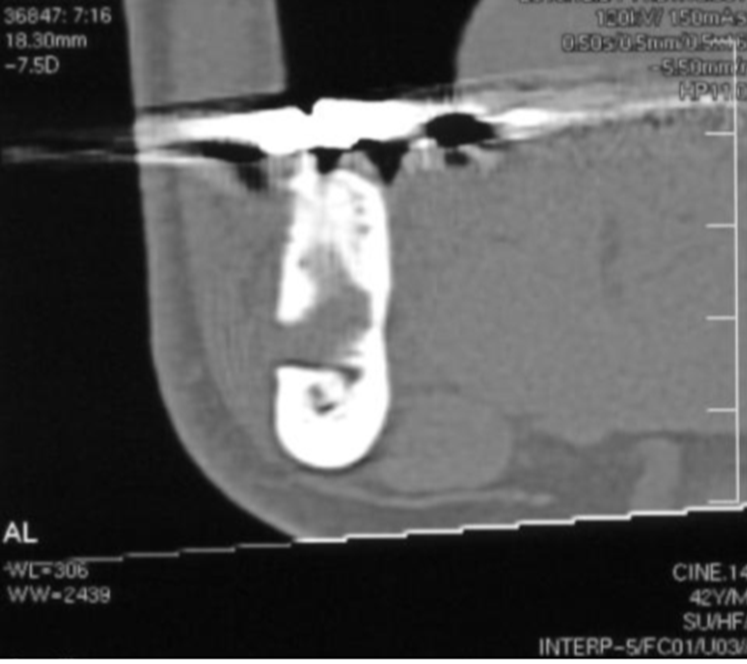下顎管とX線透過性病変