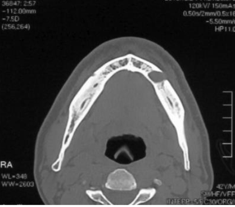 下顎管とX線透過性病変２