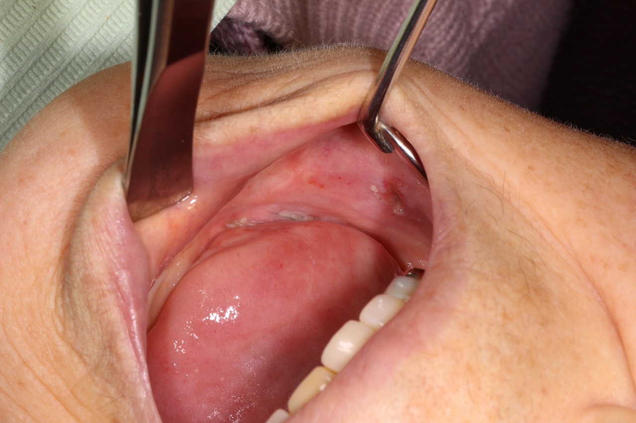 ない 口内炎 治ら ［医師監修・作成］口内炎の原因、治らない場合は他の病気に注意